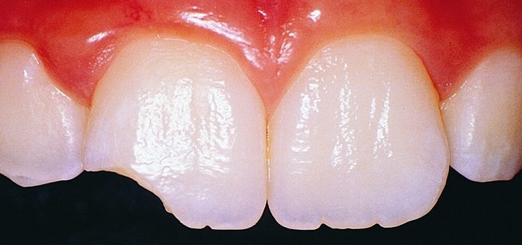 vosstanovlenie-zubov
